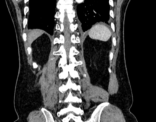 File:Abdominal aortic aneurysm (Radiopaedia 67117-76452 Coronal C+ arterial phase 92).jpg