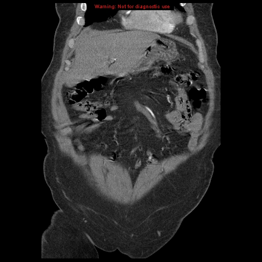 Abdominal aortic aneurysm (Radiopaedia 8190-9038 Coronal C+ arterial phase 27).jpg