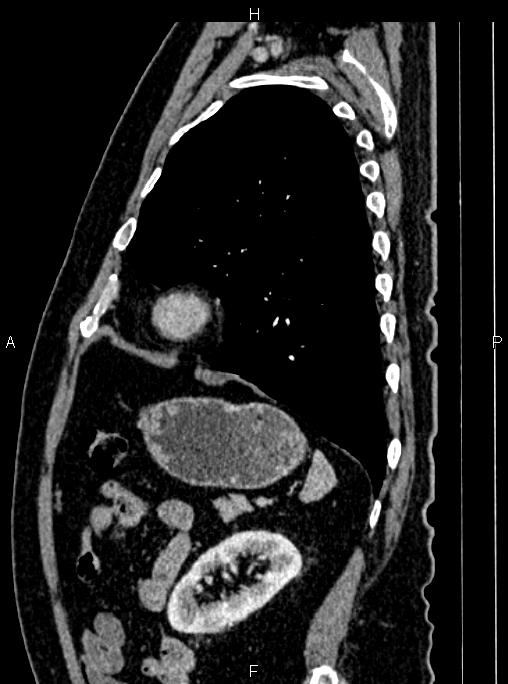 Abdominal aortic aneurysm (Radiopaedia 83094-97462 Sagittal renal cortical phase 93).jpg