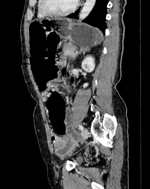 Abdominal aortic aneurysm (Radiopaedia 83581-98689 Sagittal C+ portal venous phase 82).jpg