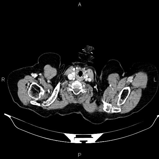 File:Abdominal aortic aneurysm (Radiopaedia 85063-100606 Axial C+ portal venous phase 3).jpg