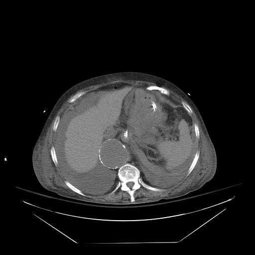 Abdominal aortic aneurysm - impending rupture (Radiopaedia 19233-19247 Axial non-contrast 38).jpg