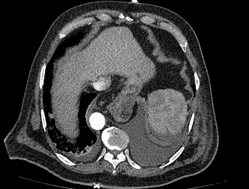 Abdominal aortic aneurysm rupture (Radiopaedia 54179-60362 Axial C+ arterial phase 18).jpg