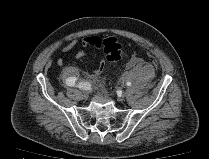 Abdominal aortic aneurysm rupture (Radiopaedia 54179-60362 Axial C+ arterial phase 45).jpg