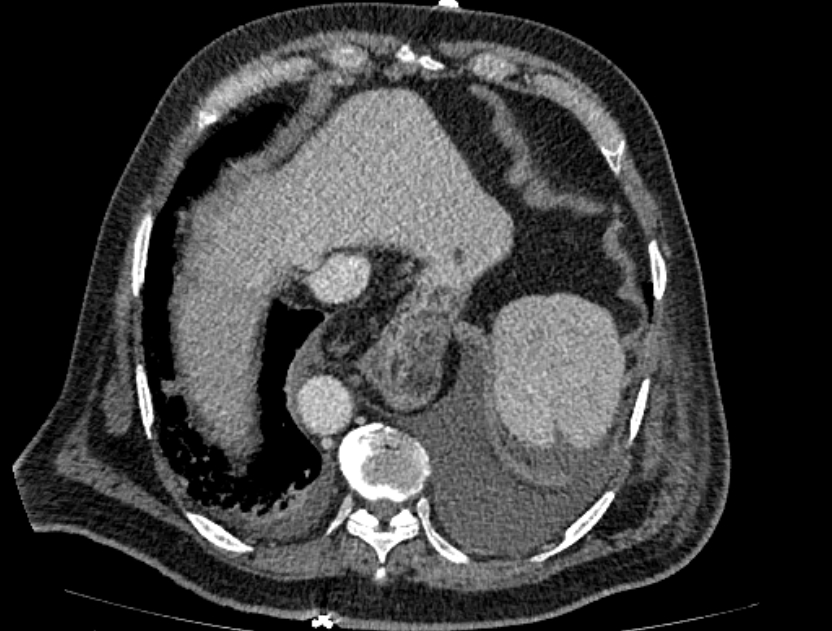 Abdominal aortic aneurysm rupture (Radiopaedia 54179-60362 Axial C+ portal venous phase 35).jpg