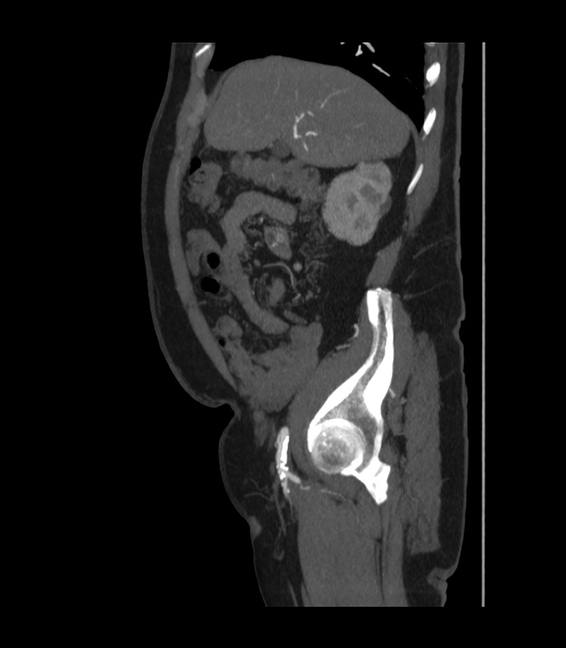 Abdominal aortic aneurysm with thrombus fissuration (Radiopaedia 46218-50618 Sagittal C+ arterial phase 15).jpg