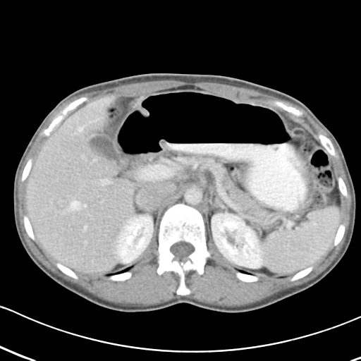 Abdominal desmoid tumor (Radiopaedia 41007-43740 Axial C+ portal venous phase 16).png