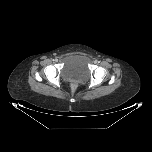 Abdominal gossypiboma- surgical towel (Radiopaedia 57288-64226 Axial C+ portal venous phase 70).jpg