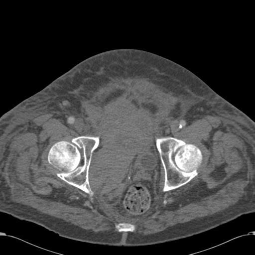 Abdominal hematoma (Radiopaedia 33614-34715 Axial C+ portal venous phase 124).png