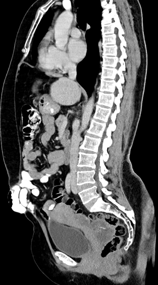Abdominal hydatid disease (Radiopaedia 68223-77737 Sagittal C+ portal venous phase 37).jpg