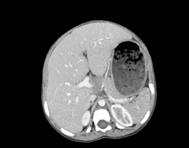 Abdominal premesenteric cystic lymphangioma (Radiopaedia 82995-97350 Axial C+ portal venous phase 14).jpg