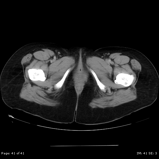 File:Abdominal wall endometriosis (Radiopaedia 25723-25885 Axial C+ portal venous phase 41).jpg