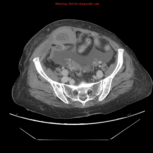 File:Abdominal wall hematoma (Radiopaedia 9427-10112 Axial C+ portal venous phase 83).jpg