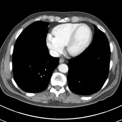 File:Abdominal wall metastasis from colorectal carcinoma (Radiopaedia 31016-31717 Axial C+ portal venous phase 8).jpg