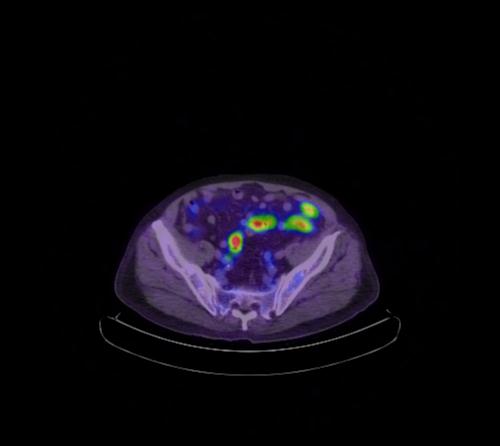 Abdominal wall metastasis from colorectal carcinoma (Radiopaedia 31016-31719 Axial 38).jpg