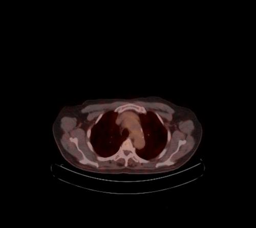 Abdominal wall metastasis from colorectal carcinoma (Radiopaedia 31016-31719 C 118).jpg