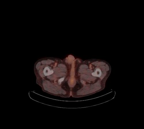 Abdominal wall metastasis from colorectal carcinoma (Radiopaedia 31016-31719 C 12).jpg