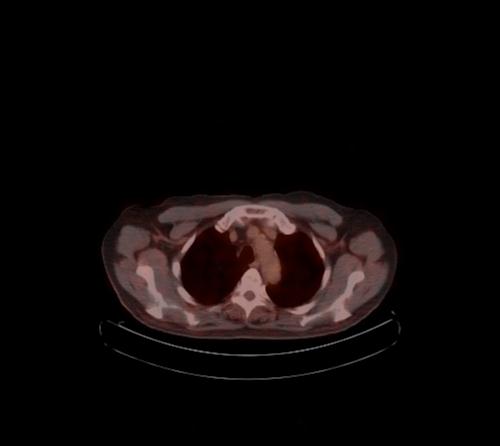 Abdominal wall metastasis from colorectal carcinoma (Radiopaedia 31016-31719 C 120).jpg