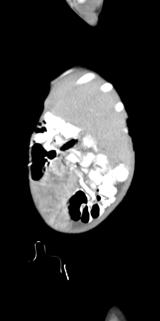 Abdominopelvic rhabdomyosarcoma (Radiopaedia 78356-90984 Sagittal C+ portal venous phase 90).jpg