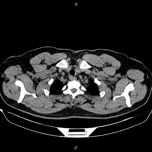 Aberrant right subclavian artery (Radiopaedia 87093-103354 Axial non-contrast 10).jpg