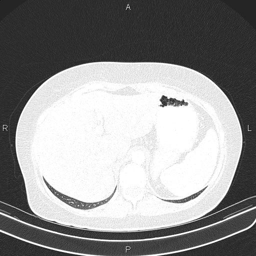Aberrant right subclavian artery (Radiopaedia 87334-103629 Axial lung window 64).jpg