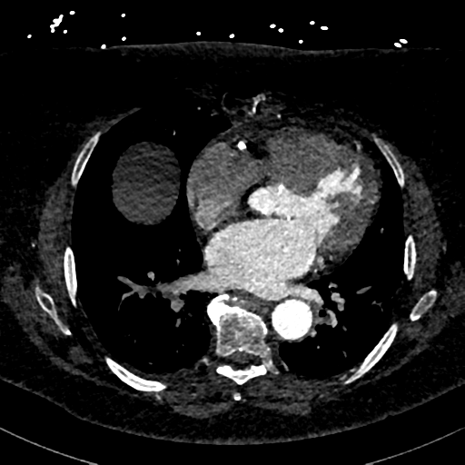 Aberrant right subclavian artery with Kommerell diverticulum (Radiopaedia 47982-52769 Axial C+ arterial phase 58).png