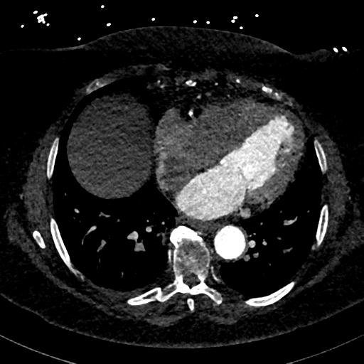 File:Aberrant right subclavian artery with Kommerell diverticulum (Radiopaedia 47982-52769 Axial C+ arterial phase 65).png
