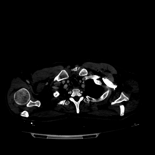 Accesory rib joint (Radiopaedia 71987-82452 Axial bone window 89).jpg