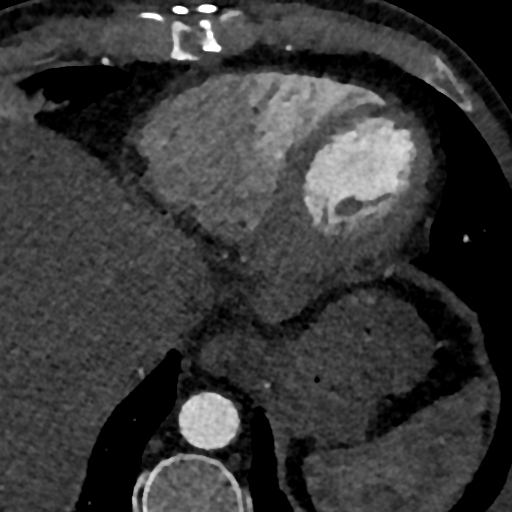 Accessory left atrial appendage (Radiopaedia 81987-95968 Axial C+ arterial phase 89).jpg