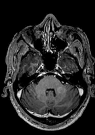 Accessory middle cerebral artery (Radiopaedia 73114-83828 Axial T1 C+ 122).jpg