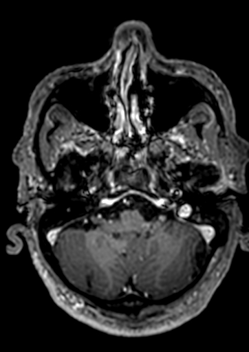 Accessory middle cerebral artery (Radiopaedia 73114-83828 Axial T1 C+ 144).jpg