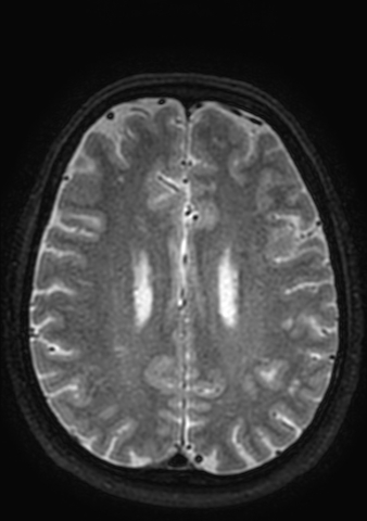 File:Accessory middle cerebral artery (Radiopaedia 73114-83828 Axial T2 12).jpg