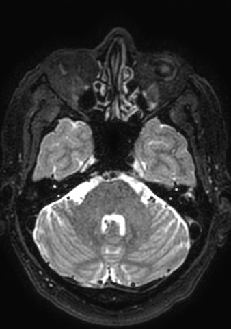 File:Accessory middle cerebral artery (Radiopaedia 73114-83828 Axial T2 158).jpg