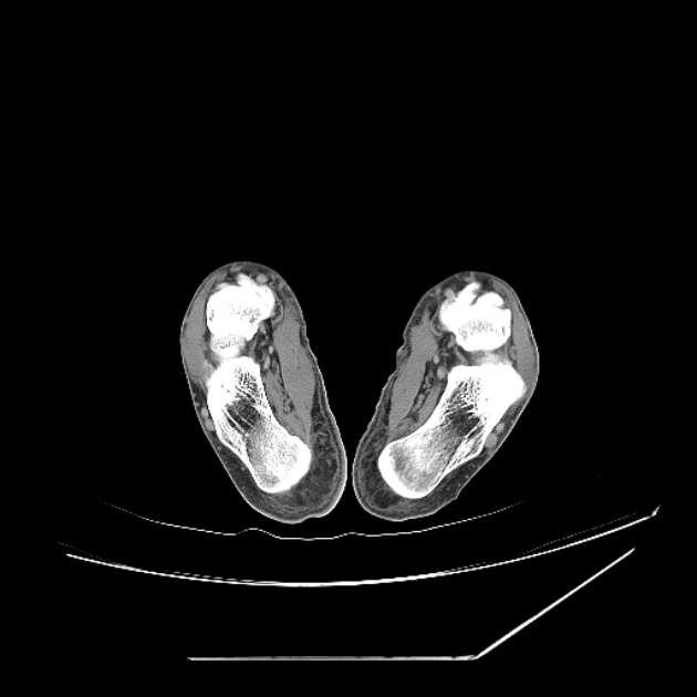 Accessory soleus muscle (Radiopaedia 61069-68943 Axial non-contrast 66).jpg