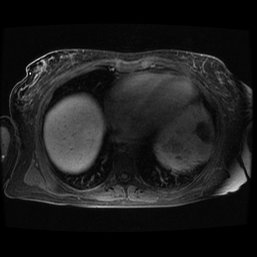 Acinar cell carcinoma of the pancreas (Radiopaedia 75442-86668 Axial late phase (~30 mins) 137).jpg