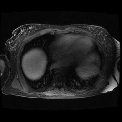 Acinar cell carcinoma of the pancreas (Radiopaedia 75442-86668 Axial late phase (~30 mins) 140).jpg
