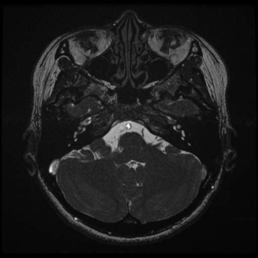 Acoustic neuroma (Radiopaedia 34049-35283 Axial 45).png