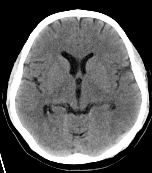 File:Acoustic schwannoma (Radiopaedia 33045-34065 Axial non-contrast 12).png