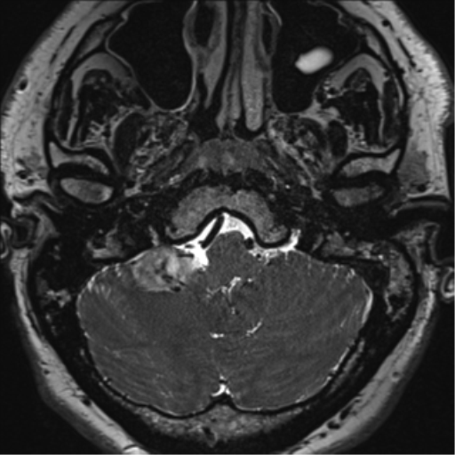 File:Acoustic schwannoma (Radiopaedia 50846-56358 Axial T2 7).png