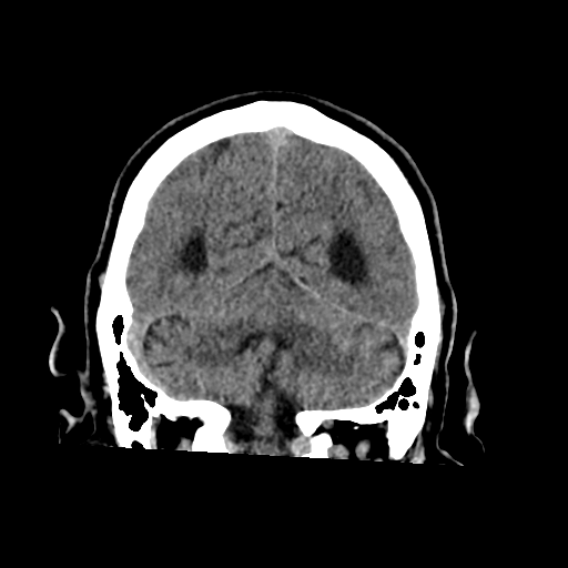 File:Acoustic schwannoma (Radiopaedia 55729-62280 Coronal non-contrast 31).png