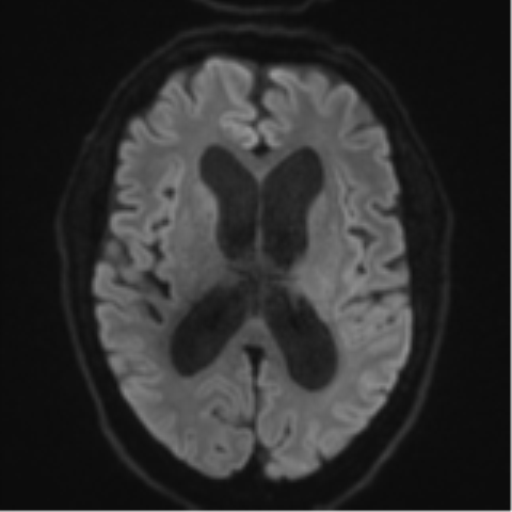 Acoustic schwannoma (Radiopaedia 55729-62281 E 42).png