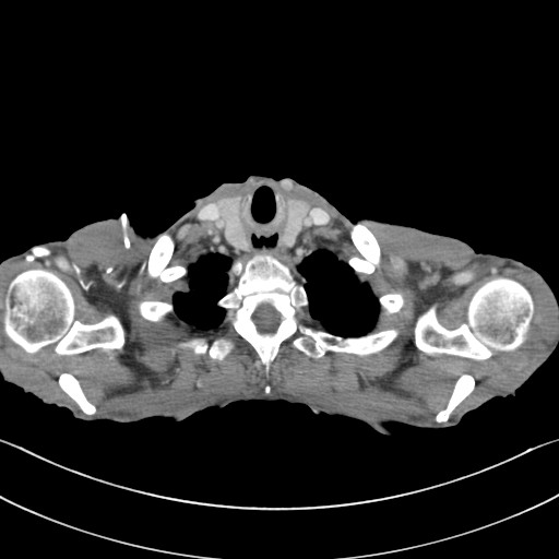 File:Acquired tracheoesophageal fistula (Radiopaedia 57747-65042 Axial C+ portal venous phase 5).jpg