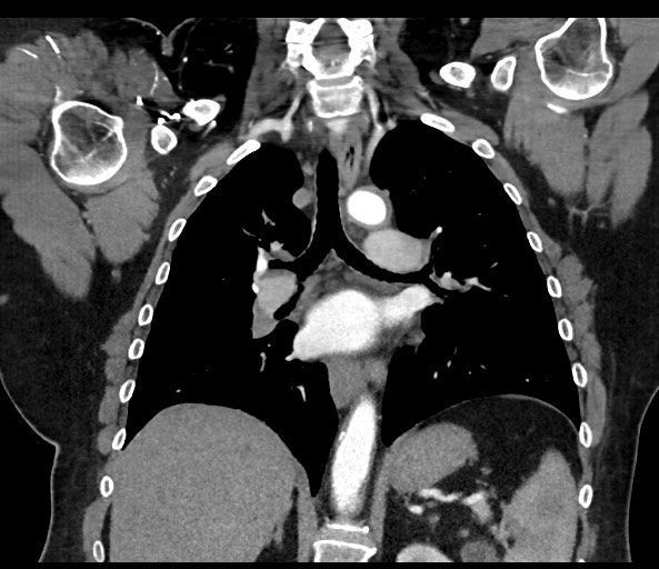 Acromioclavicular joint cyst (Radiopaedia 58455-65610 Coronal C+ arterial phase 86).jpg