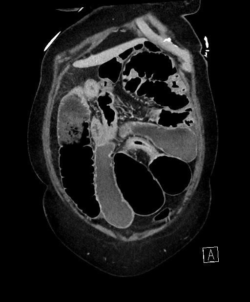 Active Crohn disease (Radiopaedia 59394-66750 Coronal C+ portal venous phase 18).jpg
