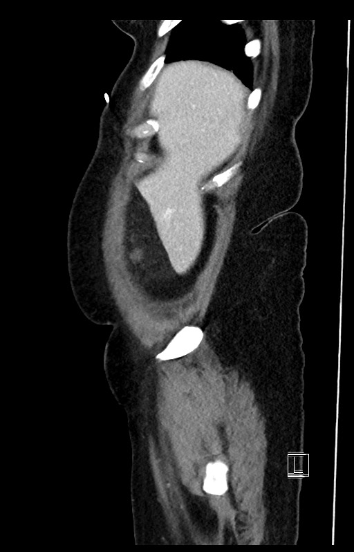 Active Crohn disease (Radiopaedia 59394-66750 Sagittal C+ portal venous phase 52).jpg