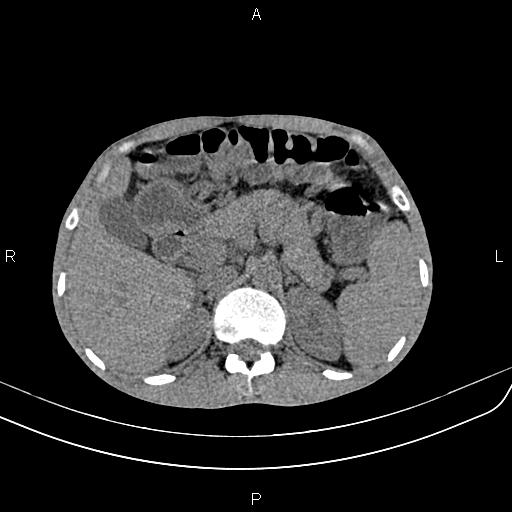 Active crohn disease (Radiopaedia 87133-103397 Axial non-contrast 29).jpg