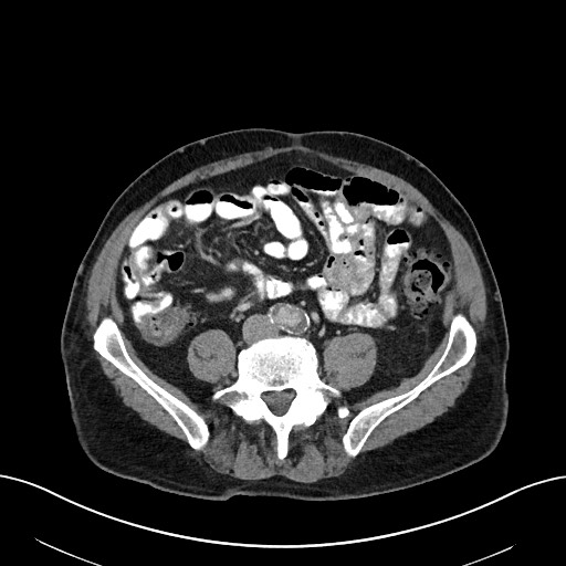 File:Active lower gastrointestinal bleeding - diverticular (Radiopaedia 61203-69106 Axial C+ portal venous phase 80).jpg