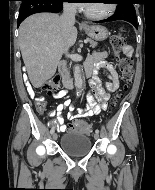 Active lower gastrointestinal bleeding - diverticular (Radiopaedia 61203-69106 Coronal C+ portal venous phase 65).jpg