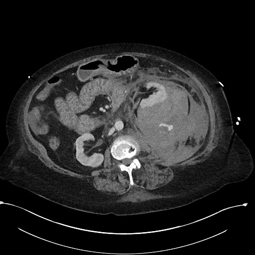 File:Active renal extravasation with large subcapsular and retroperitoneal hemorrhage (Radiopaedia 60975-68796 Axial 255).jpg