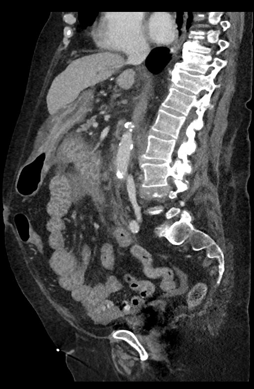 Active renal extravasation with large subcapsular and retroperitoneal hemorrhage (Radiopaedia 60975-68796 Sagittal C+ portal venous phase 126).jpg